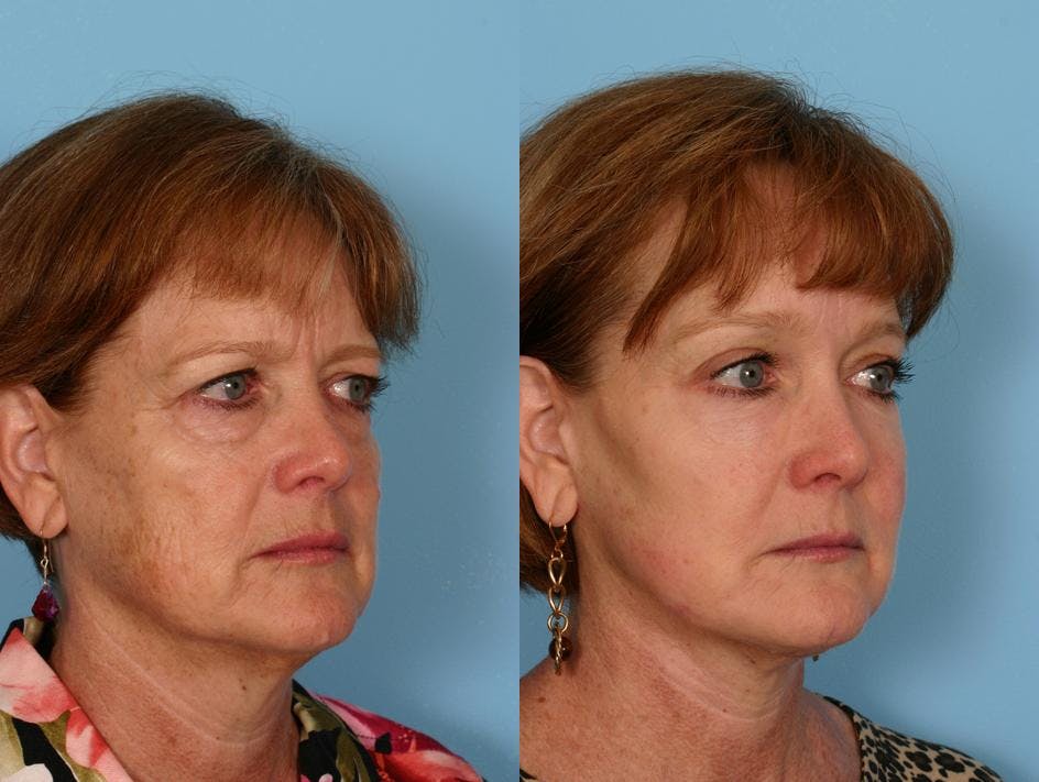 Endoscopic Brow Lift Before & After Gallery - Patient 348502 - Image 2