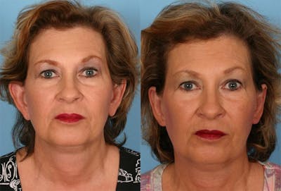 Ear Surgery (Otoplasty) Before & After Gallery - Patient 282136 - Image 1
