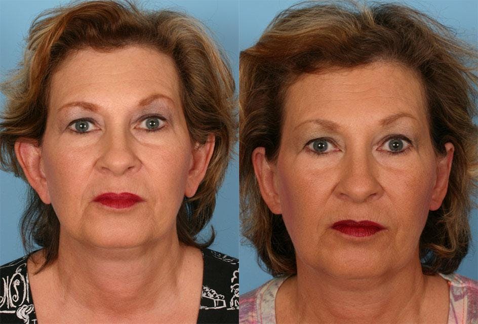 Ear Surgery (Otoplasty) Before & After Gallery - Patient 282136 - Image 1