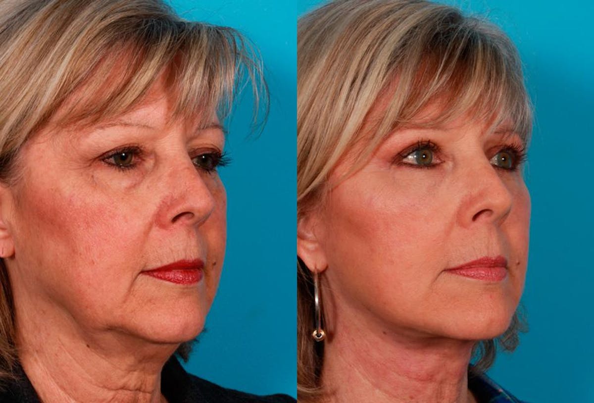 Facial Fat Transfer Before & After Gallery - Patient 786981 - Image 2