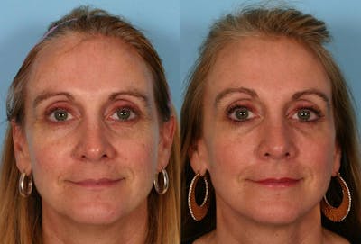 CO2 Fractional Laser Before & After Gallery - Patient 363487 - Image 1