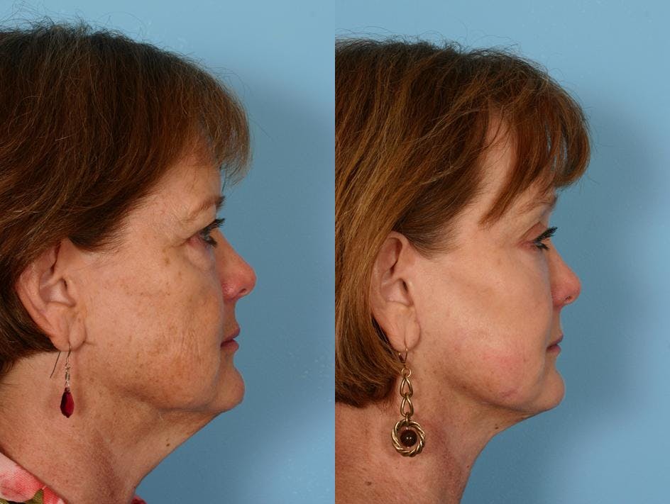 Endoscopic Brow Lift Before & After Gallery - Patient 348502 - Image 3
