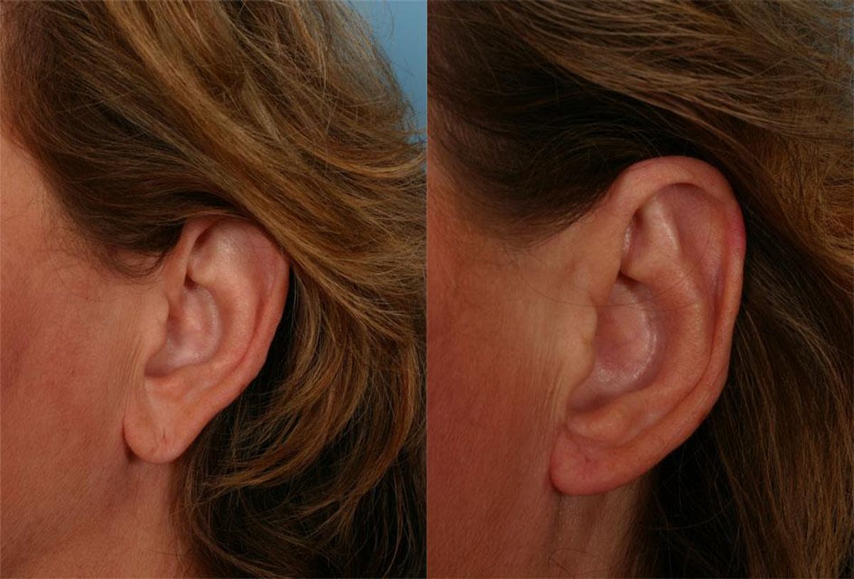 Ear Surgery (Otoplasty) Before & After Gallery - Patient 282136 - Image 2