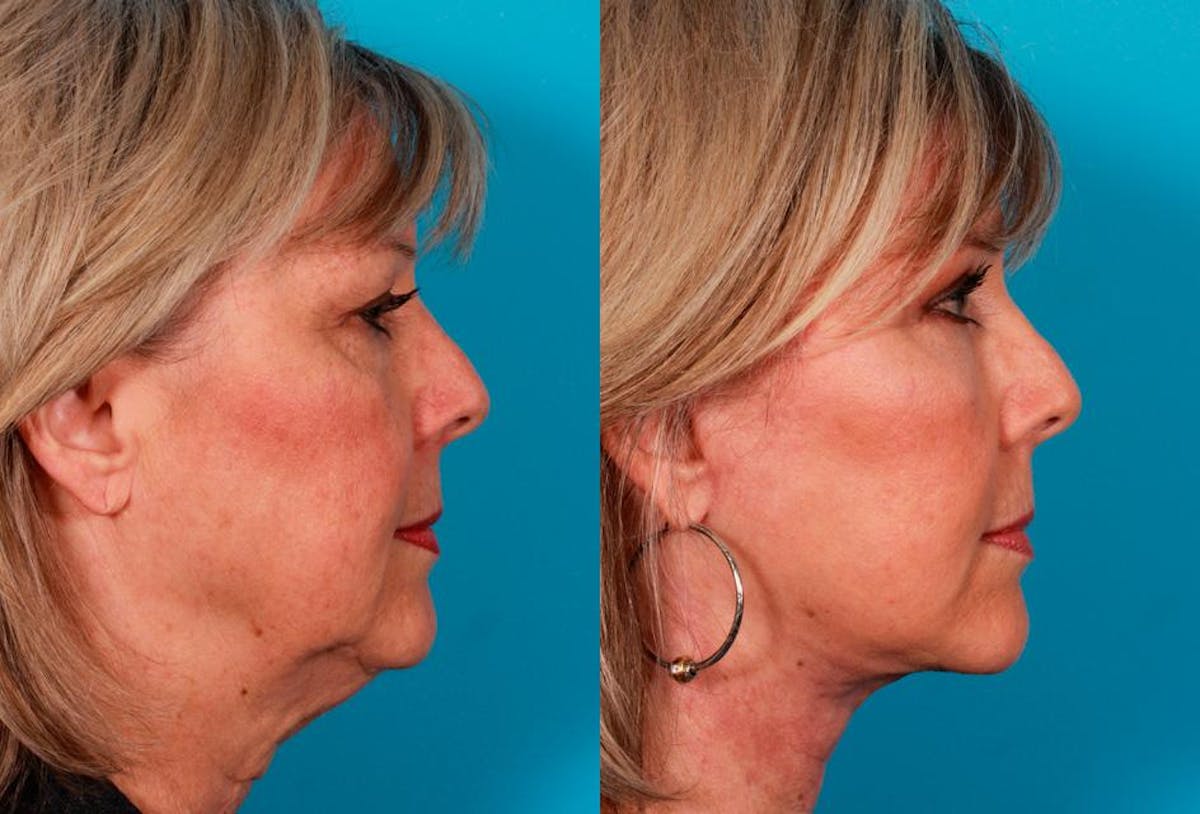 Facial Fat Transfer Before & After Gallery - Patient 786981 - Image 3