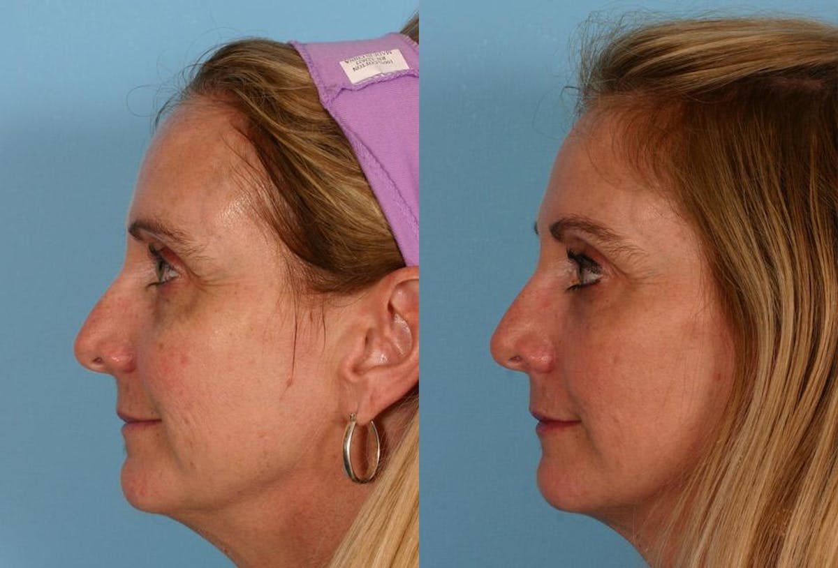 CO2 Fractional Laser Before & After Gallery - Patient 363487 - Image 2