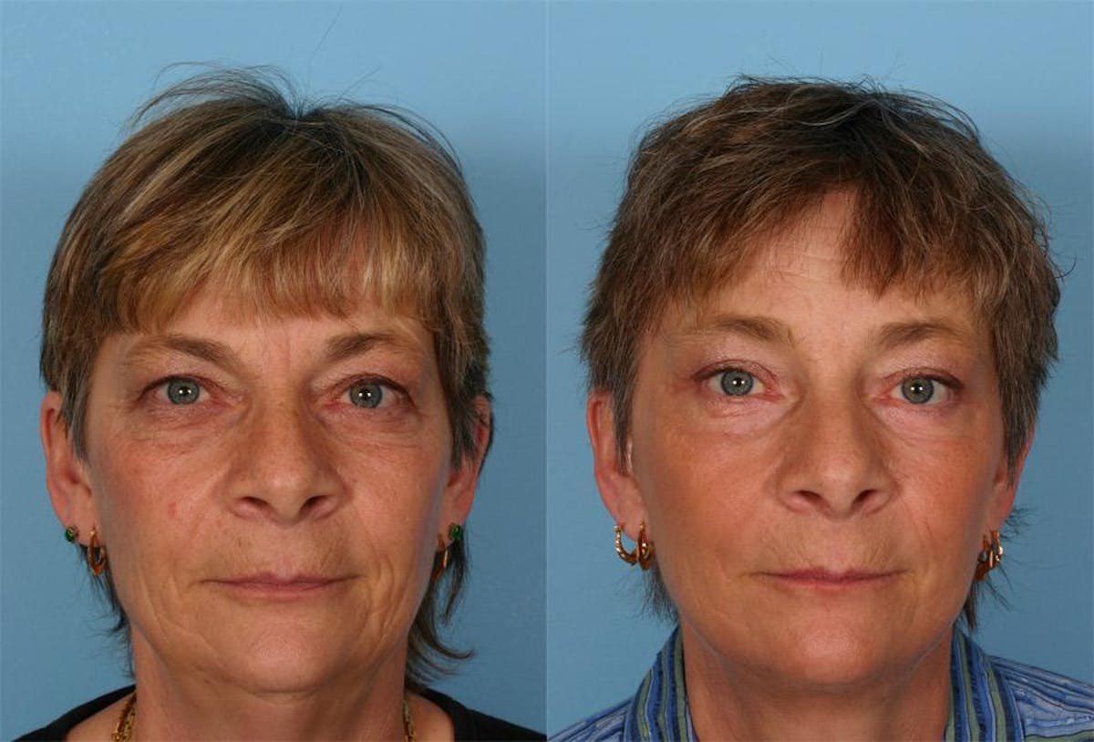 Endoscoplic Browlift Before & After Gallery - Patient 131082 - Image 1