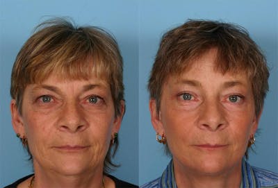 Endoscoplic Browlift Before & After Gallery - Patient 131082 - Image 1
