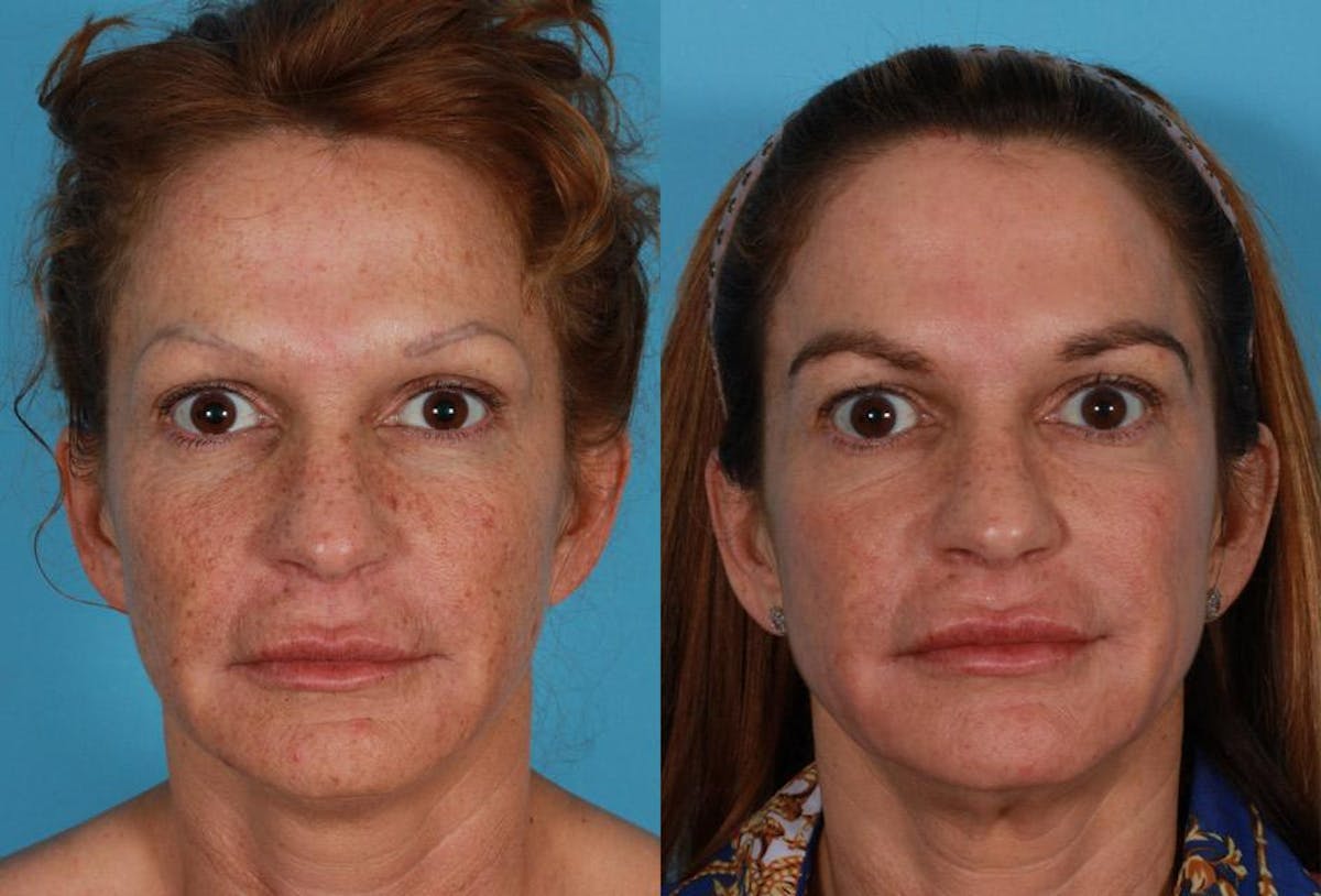 CO2 Fractional Laser Before & After Gallery - Patient 404023 - Image 1