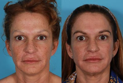Fractional Laser Before & After Gallery - Patient 404023 - Image 1