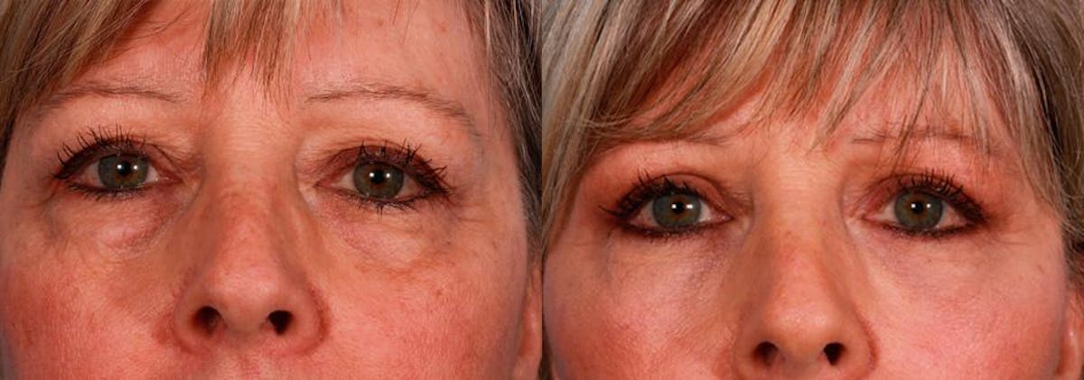Facelift Before & After Gallery - Patient 205003 - Image 4