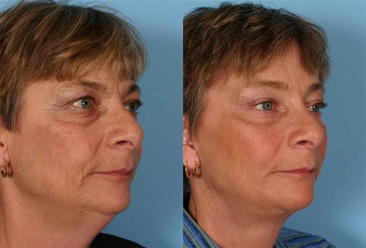 Endoscoplic Browlift Before & After Gallery - Patient 131082 - Image 2