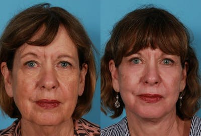 Facial Fat Transfer Before & After Gallery - Patient 175972 - Image 1