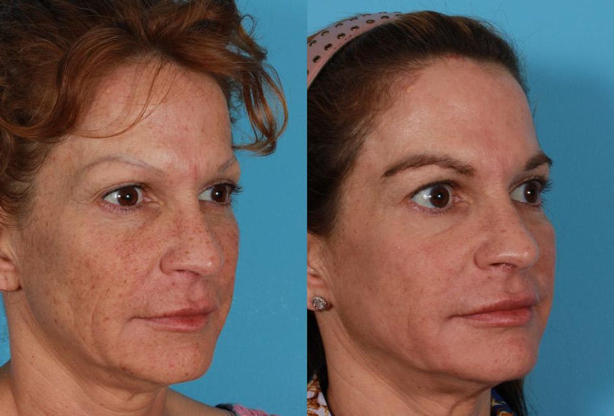 CO2 Fractional Laser Before & After Gallery - Patient 404023 - Image 2