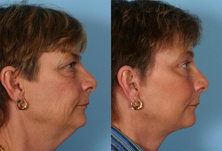 Endoscopic Brow Lift Before & After Gallery - Patient 131082 - Image 3