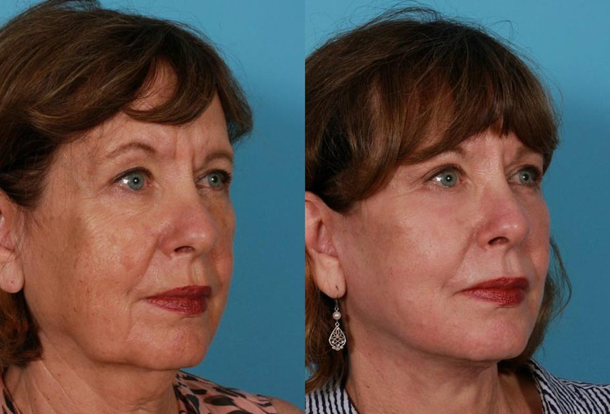 Facial Fat Transfer Before & After Gallery - Patient 175972 - Image 2