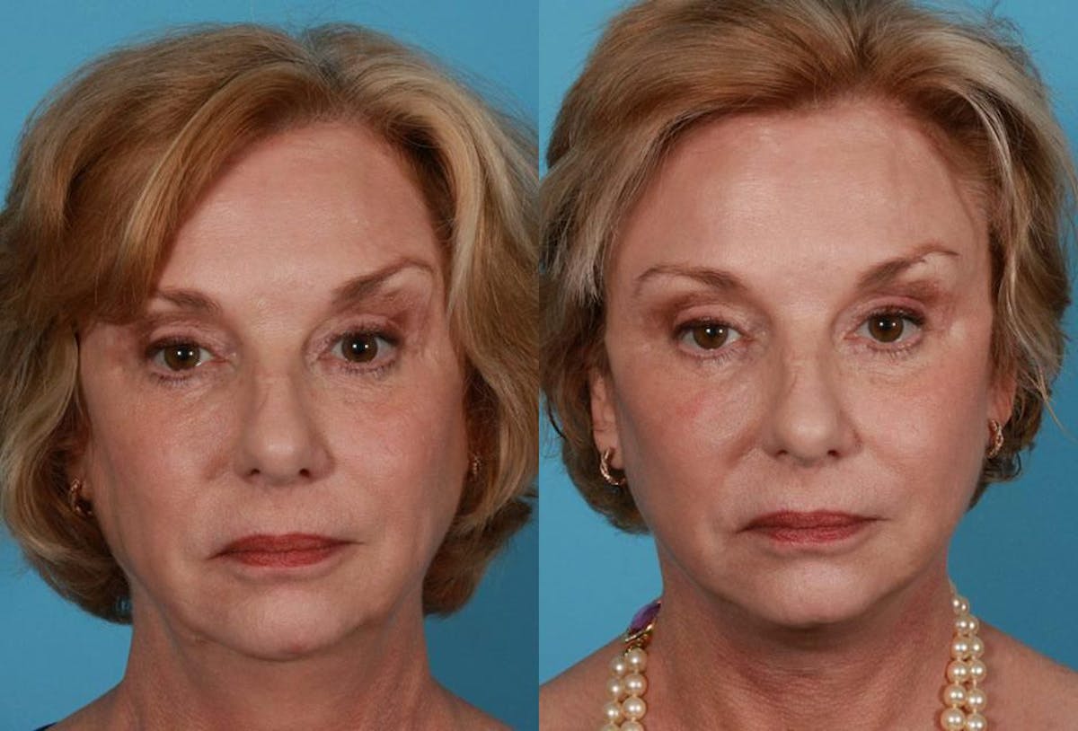 Facelift Before & After Gallery - Patient 175212 - Image 1