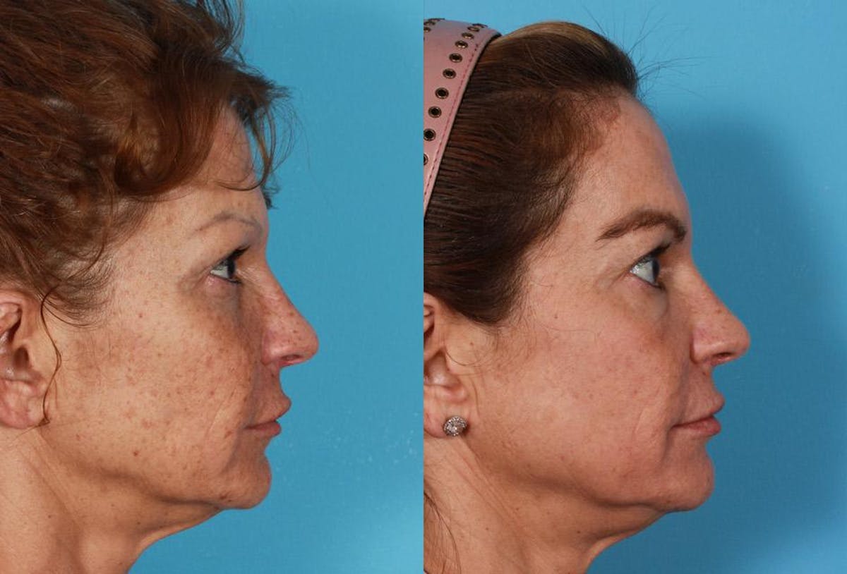 CO2 Fractional Laser Before & After Gallery - Patient 404023 - Image 3