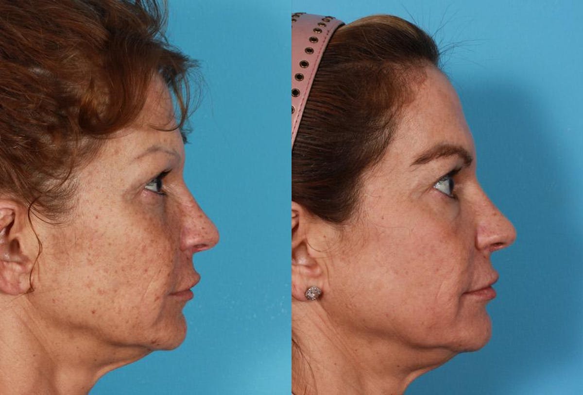 Fractional Laser Before & After Gallery - Patient 404023 - Image 3