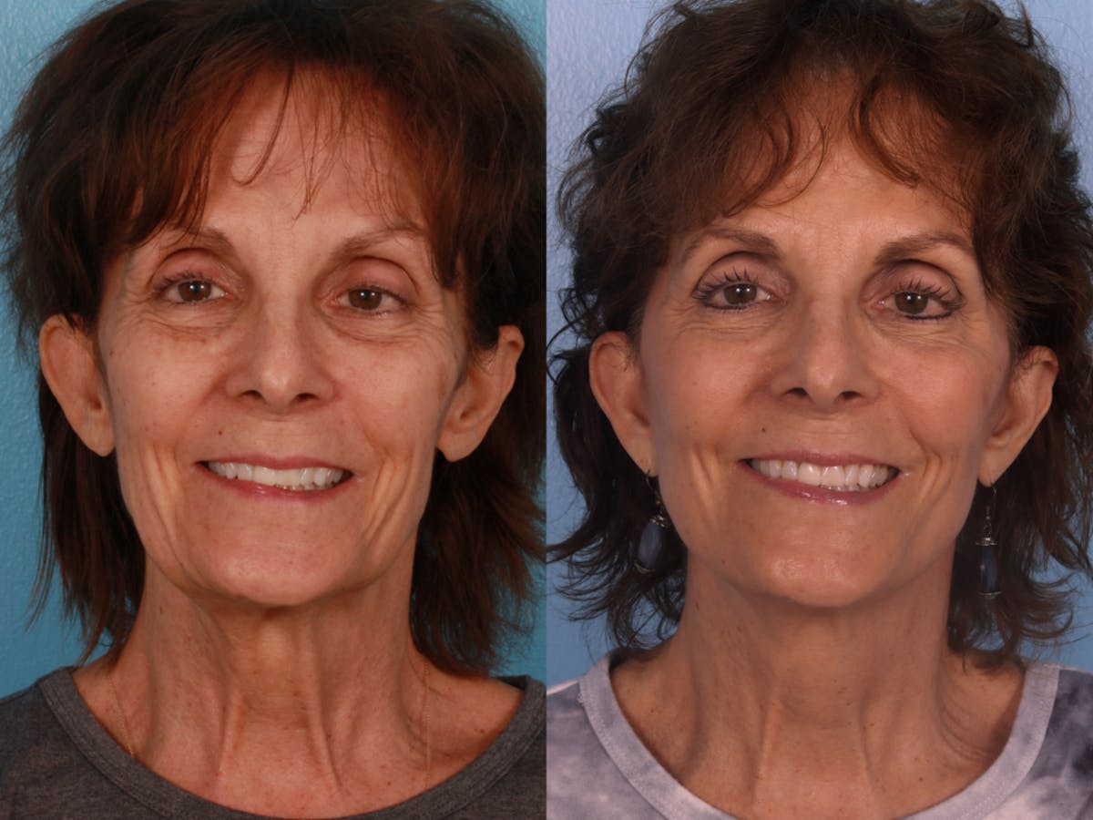 Limited Incision Facelift Before & After Gallery - Patient 307006 - Image 1