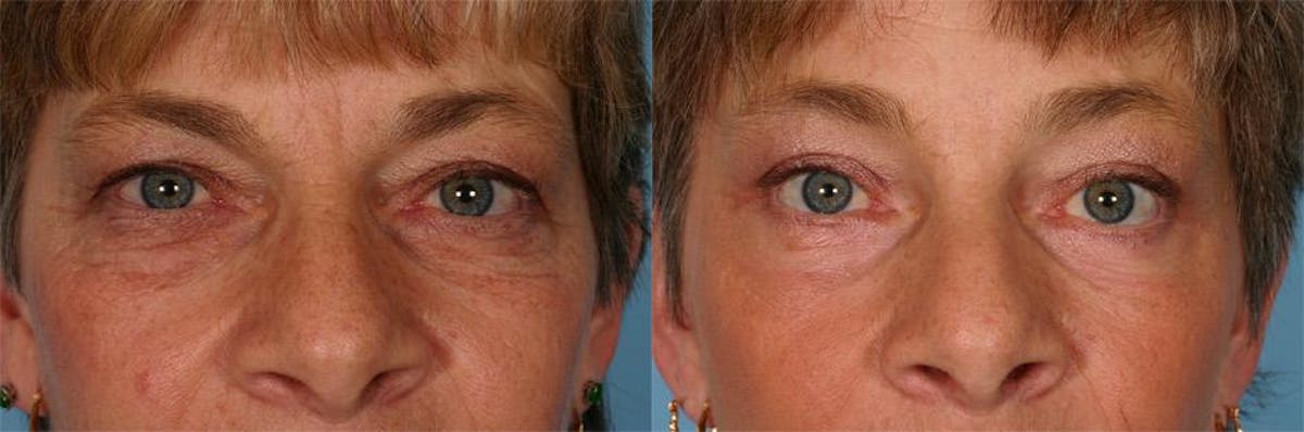 Endoscoplic Browlift Before & After Gallery - Patient 131082 - Image 4