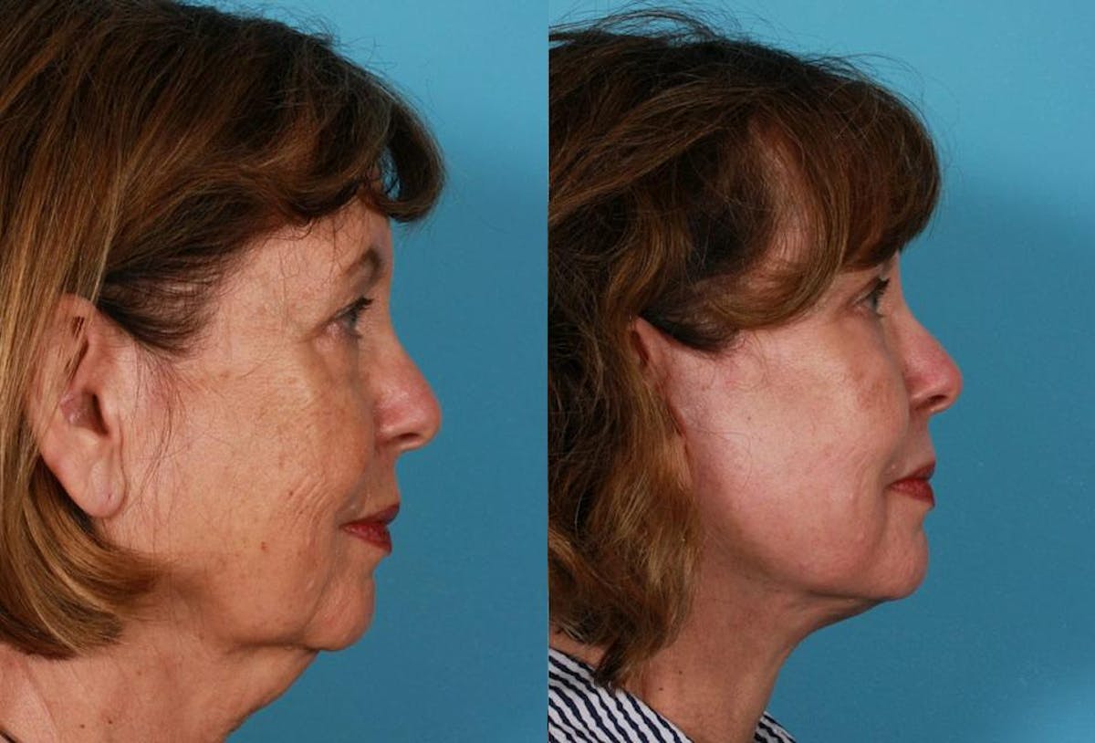 Facial Fat Transfer Before & After Gallery - Patient 175972 - Image 3