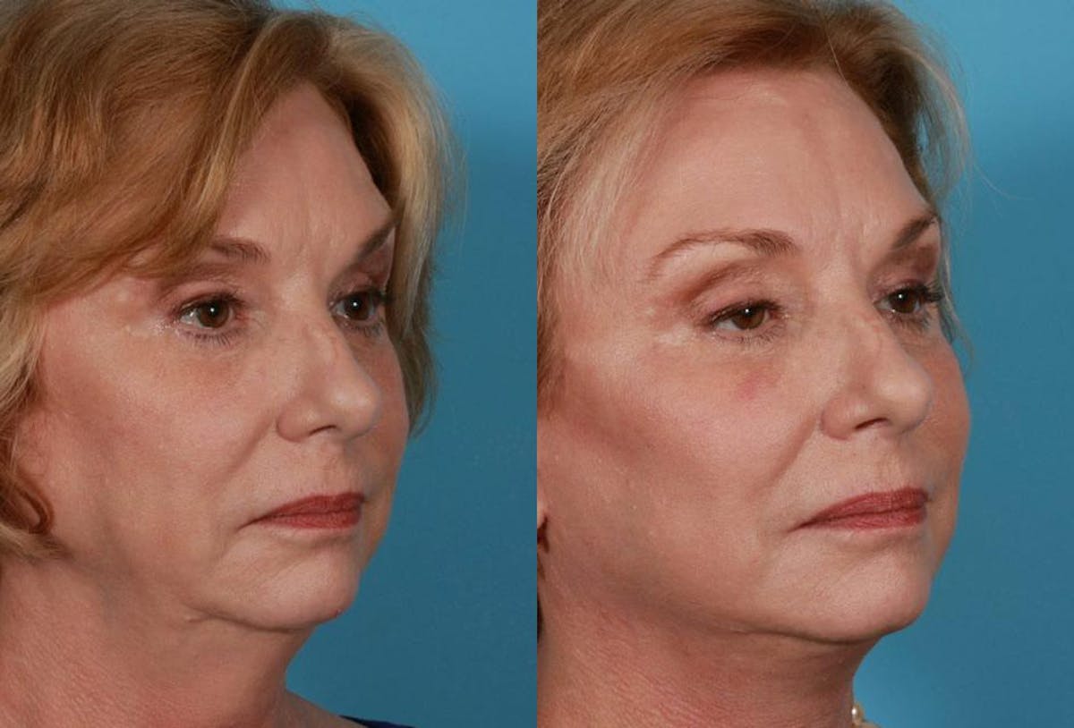 Facelift Before & After Gallery - Patient 175212 - Image 2