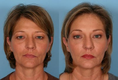 Endoscoplic Browlift Before & After Gallery - Patient 348487 - Image 1
