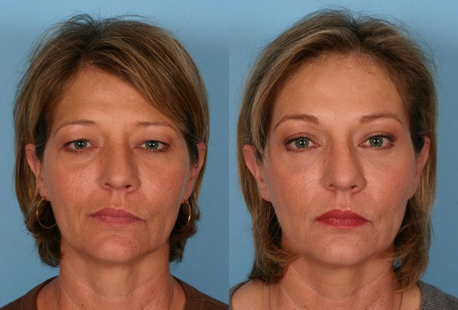 Endoscopic Brow Lift Before & After Gallery - Patient 348487 - Image 1