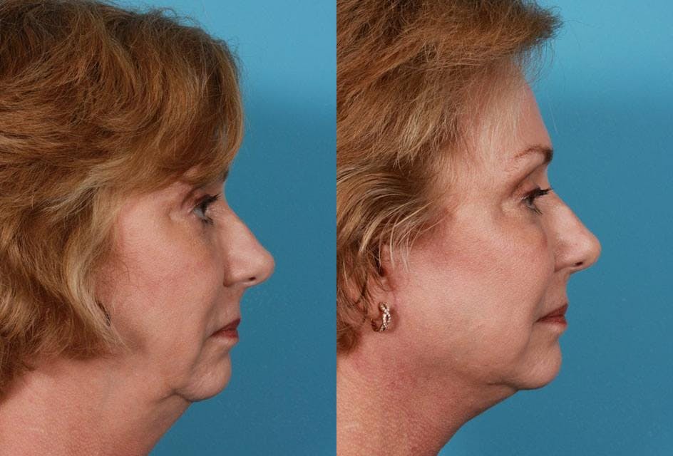 Facelift Before & After Gallery - Patient 175212 - Image 3