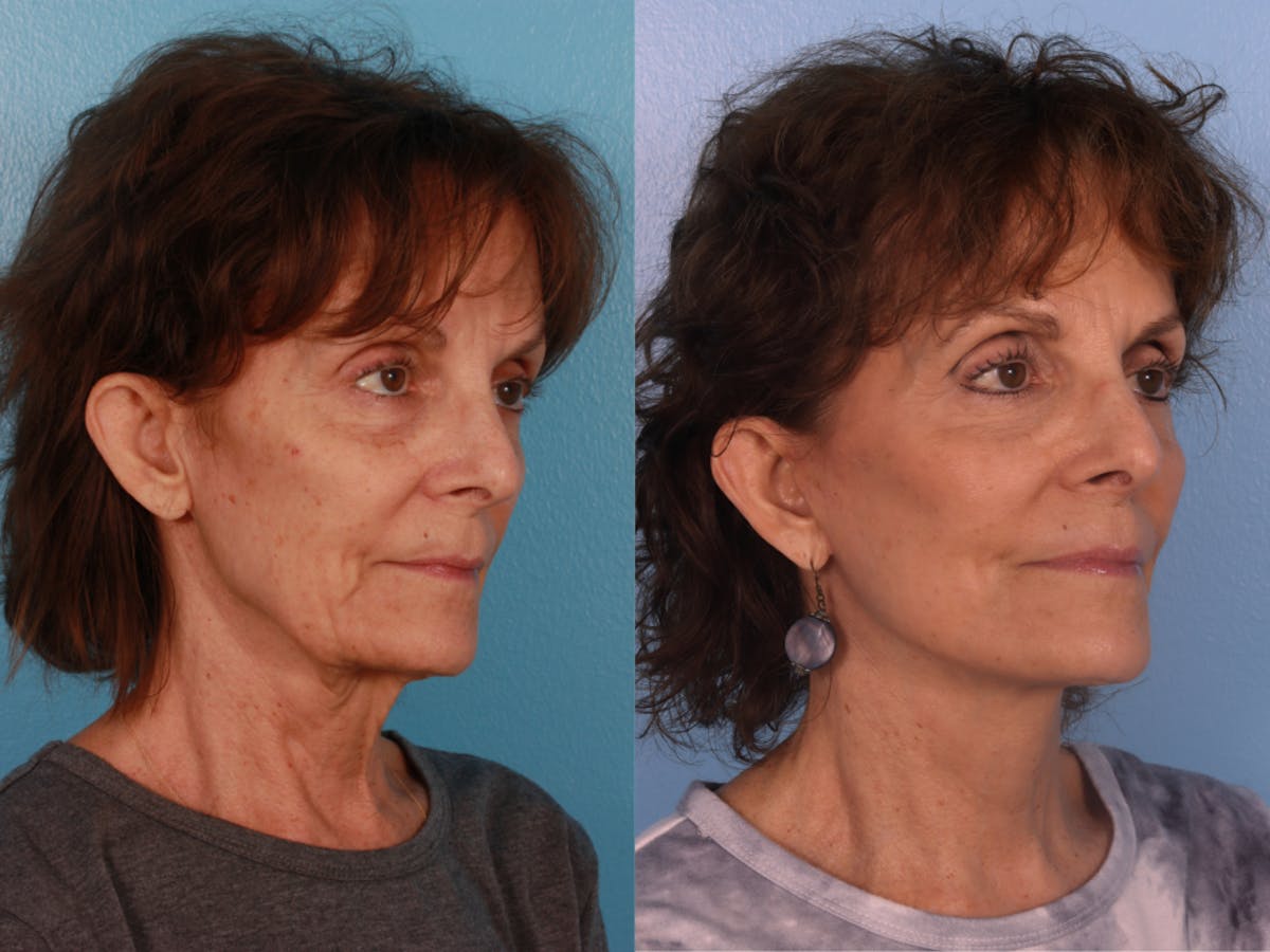 Limited Incision Facelift Before & After Gallery - Patient 307006 - Image 2