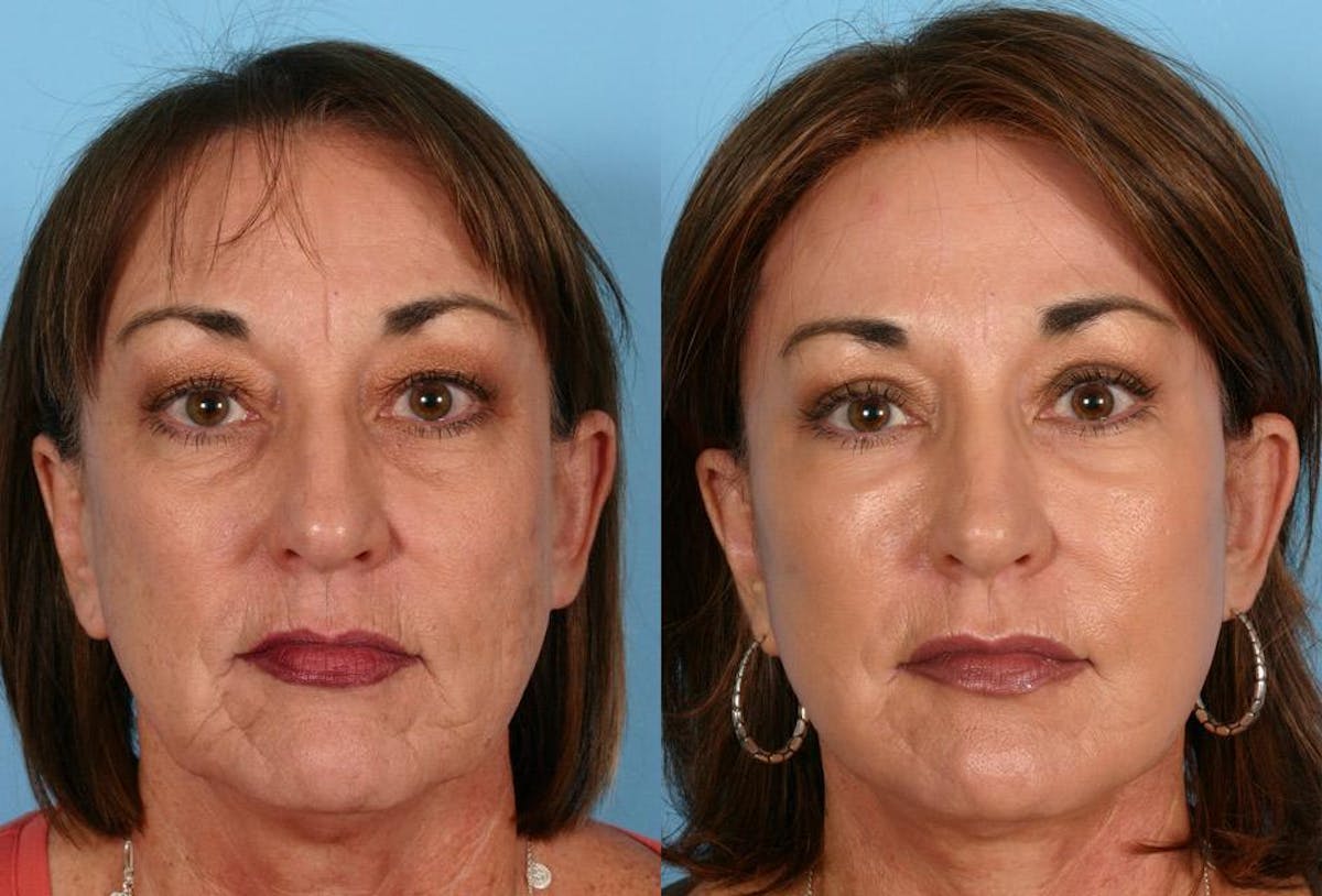 Facial Fat Transfer Before & After Gallery - Patient 421099 - Image 1