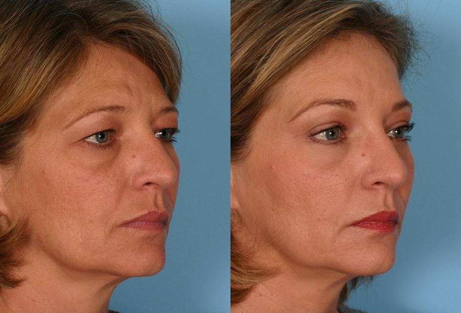 Endoscopic Brow Lift Before & After Gallery - Patient 348487 - Image 2