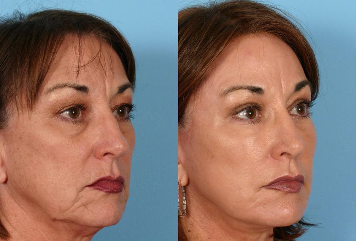Facial Fat Transfer Before & After Gallery - Patient 421099 - Image 2