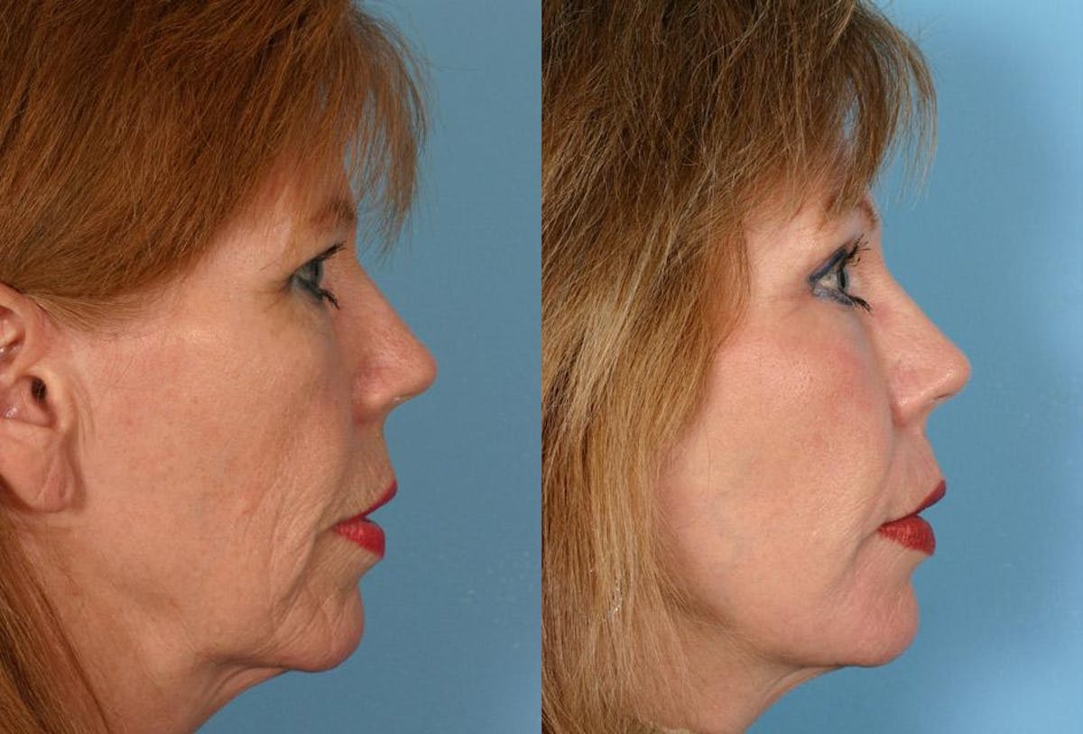 CO2 Fractional Laser Before & After Gallery - Patient 346904 - Image 3