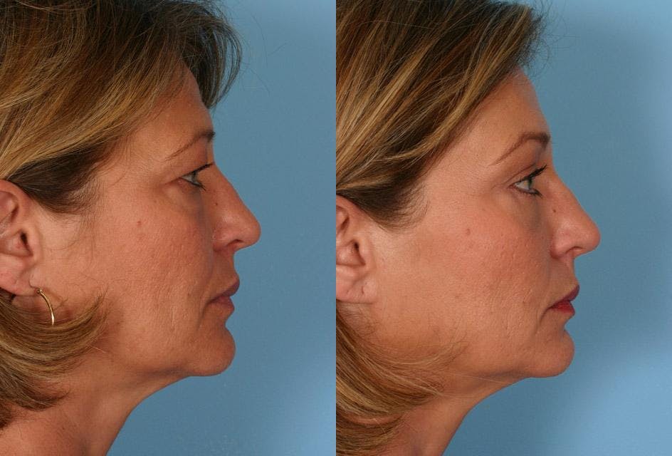 Endoscopic Brow Lift Before & After Gallery - Patient 348487 - Image 3