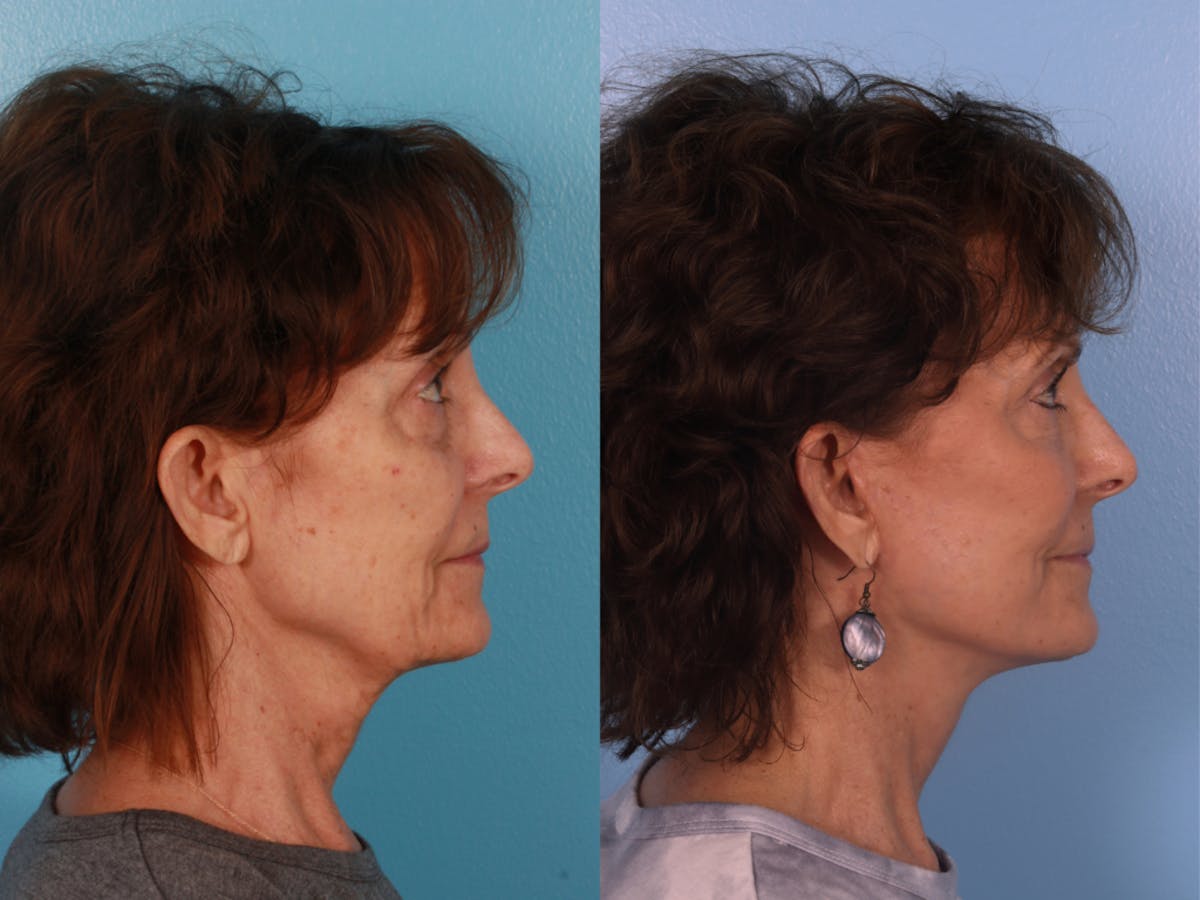 Limited Incision Facelift Before & After Gallery - Patient 307006 - Image 3