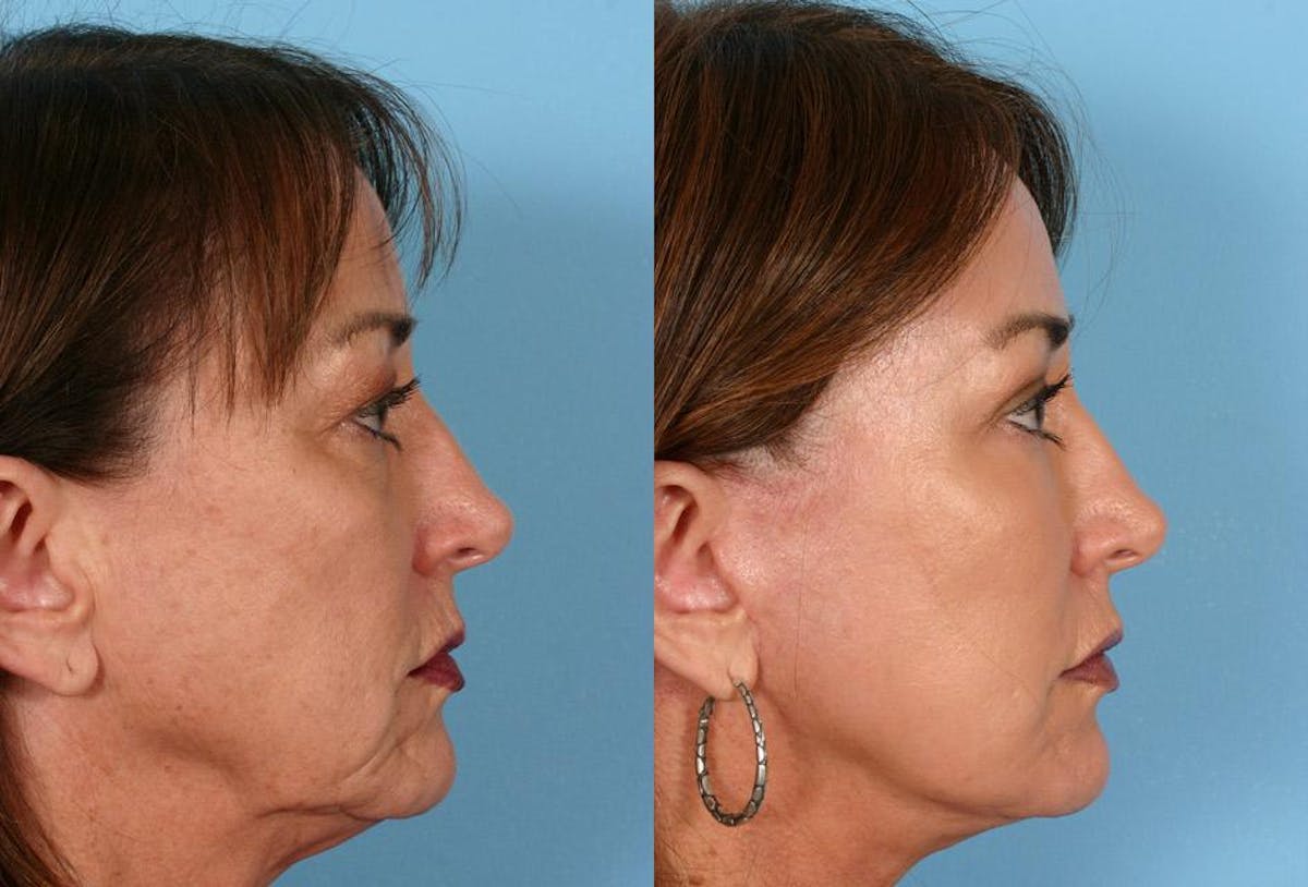 Facial Fat Transfer Before & After Gallery - Patient 421099 - Image 3