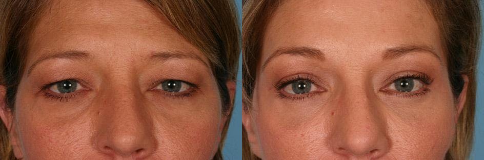 Endoscopic Brow Lift Before & After Gallery - Patient 348487 - Image 4