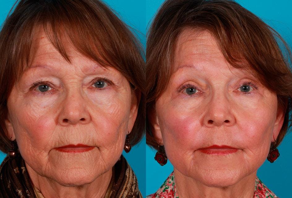 CO2 Fractional Laser Before & After Gallery - Patient 424988 - Image 1