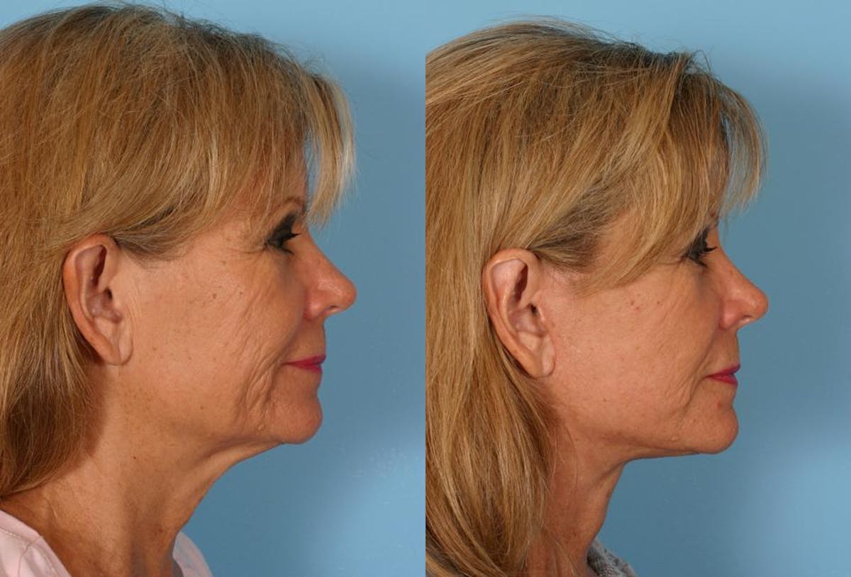 Ear Surgery (Otoplasty) Before & After Gallery - Patient 175043 - Image 2