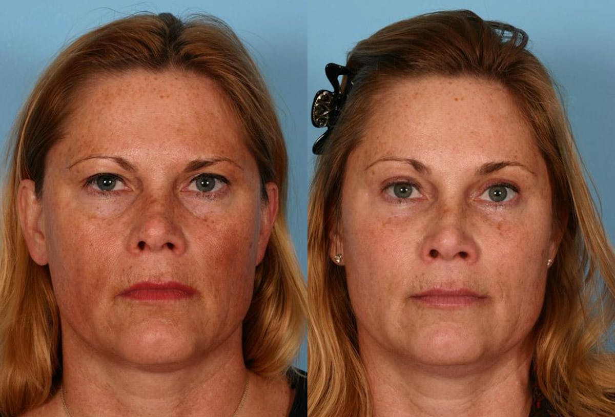 Endoscoplic Browlift Before & After Gallery - Patient 370813 - Image 1