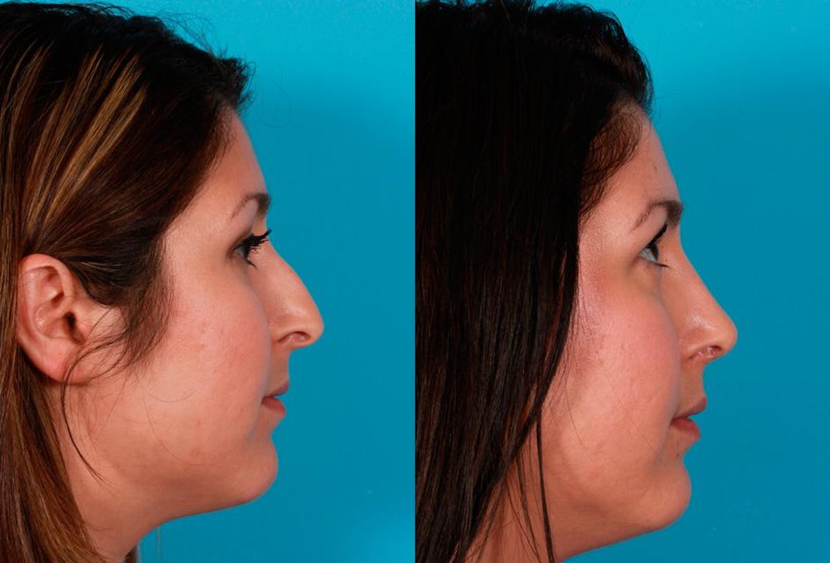 Nasal Obstruction Before & After Gallery - Patient 390109 - Image 2