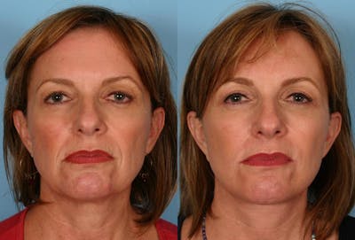 Facelift Before & After Gallery - Patient 332223 - Image 1