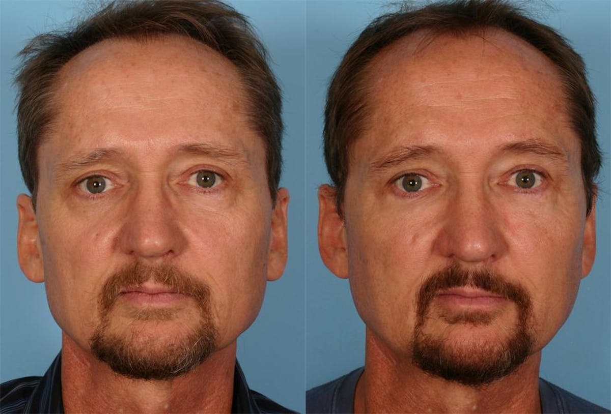 Facial Fat Transfer Before & After Gallery - Patient 421566 - Image 1