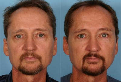 Facial Fat Transfer Before & After Gallery - Patient 421566 - Image 1