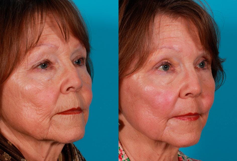 CO2 Fractional Laser Before & After Gallery - Patient 424988 - Image 2