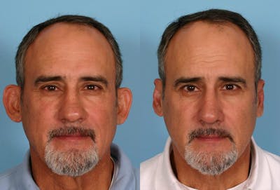 Ear Surgery (Otoplasty) Before & After Gallery - Patient 367756 - Image 1