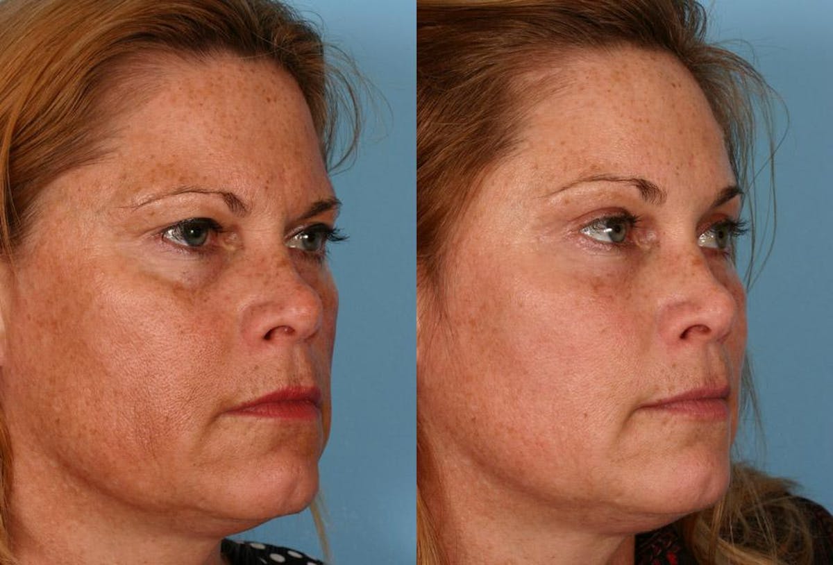 Endoscoplic Browlift Before & After Gallery - Patient 370813 - Image 2