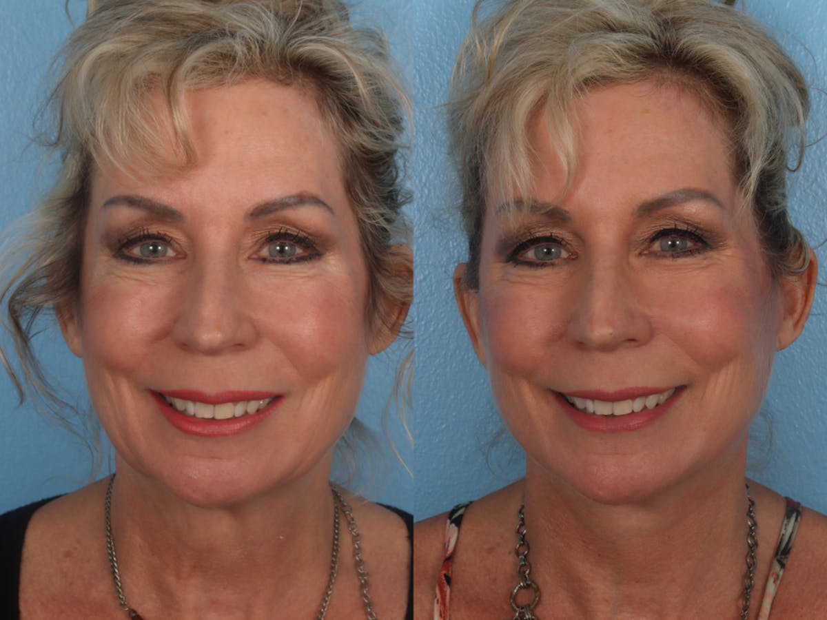 Limited Incision Facelift Before & After Gallery - Patient 363758 - Image 1