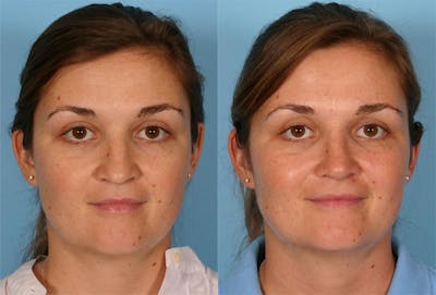 Nasal Obstruction Before & After Gallery - Patient 259126 - Image 1